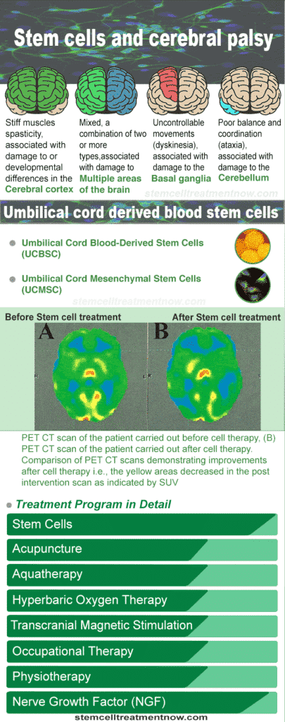 als stem cell treatment cost